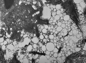 jejunum … lipid malabsorption jejunum … lipid malabsorption